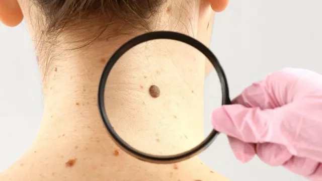 Este fin de semana La Roche-Posay puso a disposición de la población chequeos gratuitos de lunares con dermatólogos durante dos días