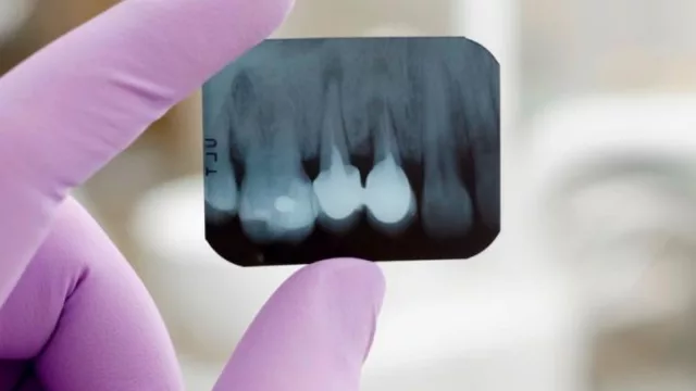 Sonría, estamos sacando una foto a lo invisible (radiografías odontológicas detectan lesiones incidentales)